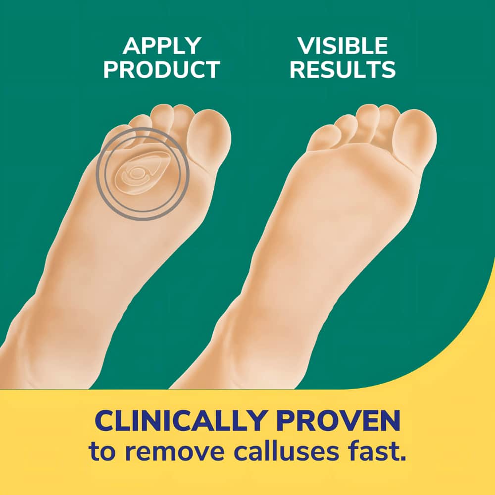 Dr. Scholl’s® Callus Removers with Duragel™ technology