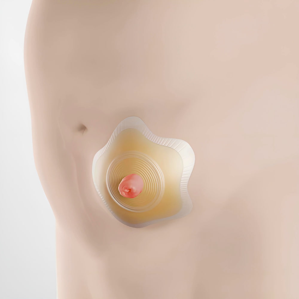 Coloplast SenSura Mio Concave 2 piece Click Baseplate Item 18511